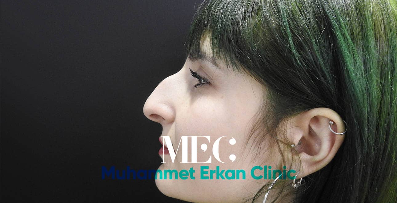 Burun Estetiği Öncesi Burun Estetiği Öncesi
